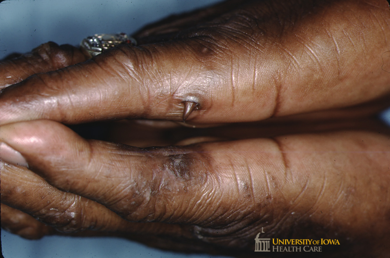 Elongated conical keratotic projection on the right lateral 5th digit and keratotic papule with surrounding hyperpigmentation on the left lateral 5th digit. (click images for higher resolution).